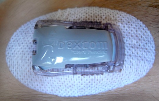 Dexcom sensor